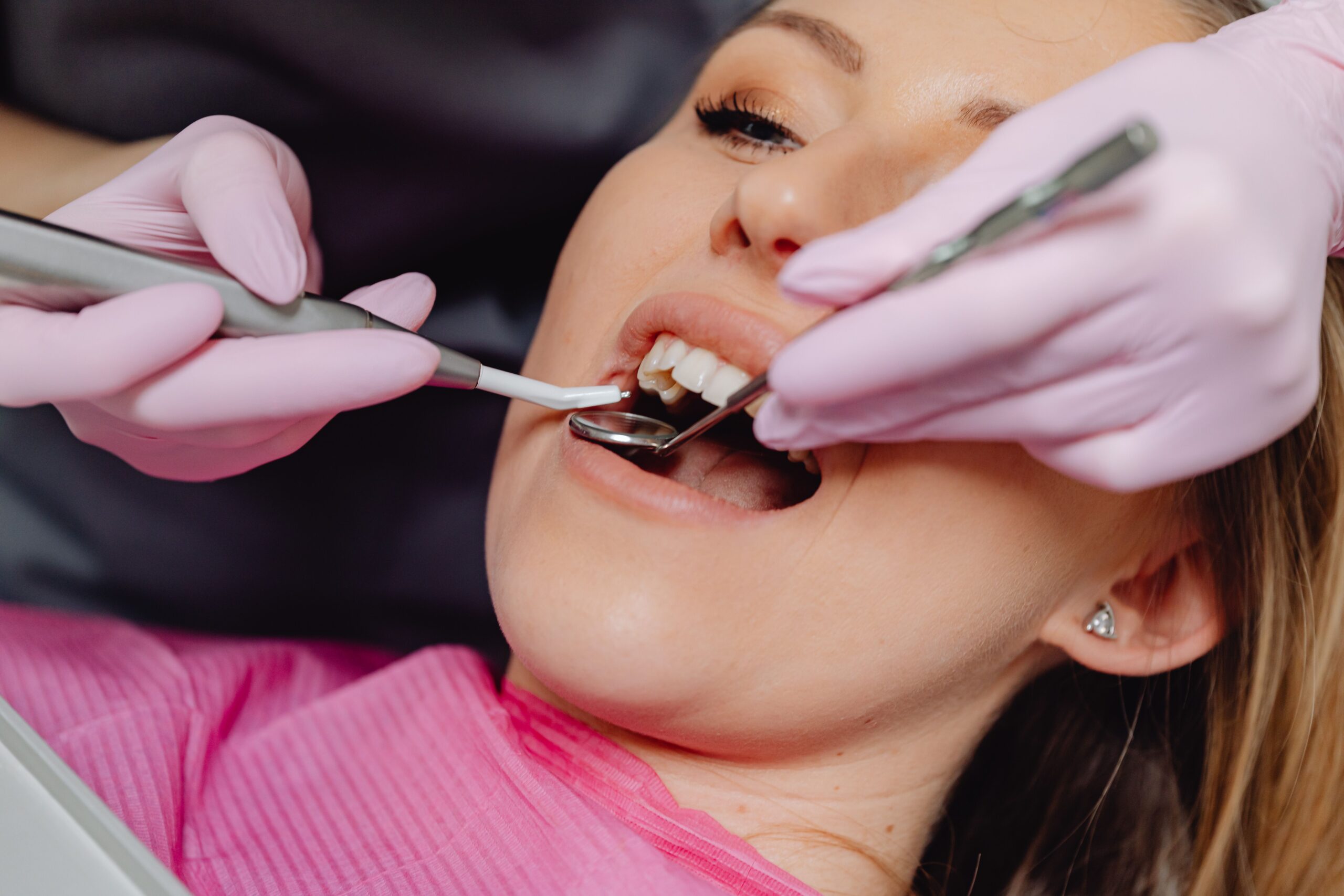 TSB pode fazer limpeza dentária?